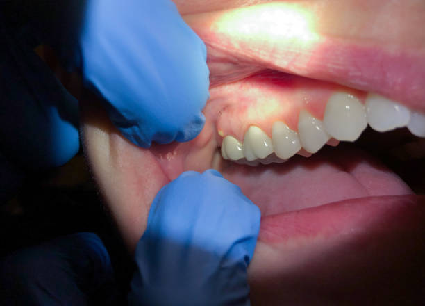 Best Emergency Gum Treatment in Monroe, NC