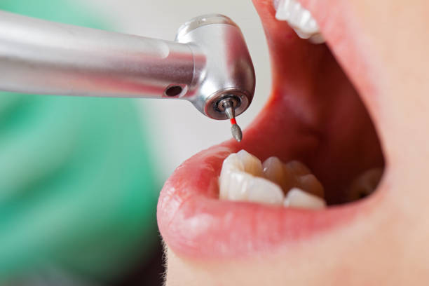 Best Emergency Tooth Extraction in Monroe, NC